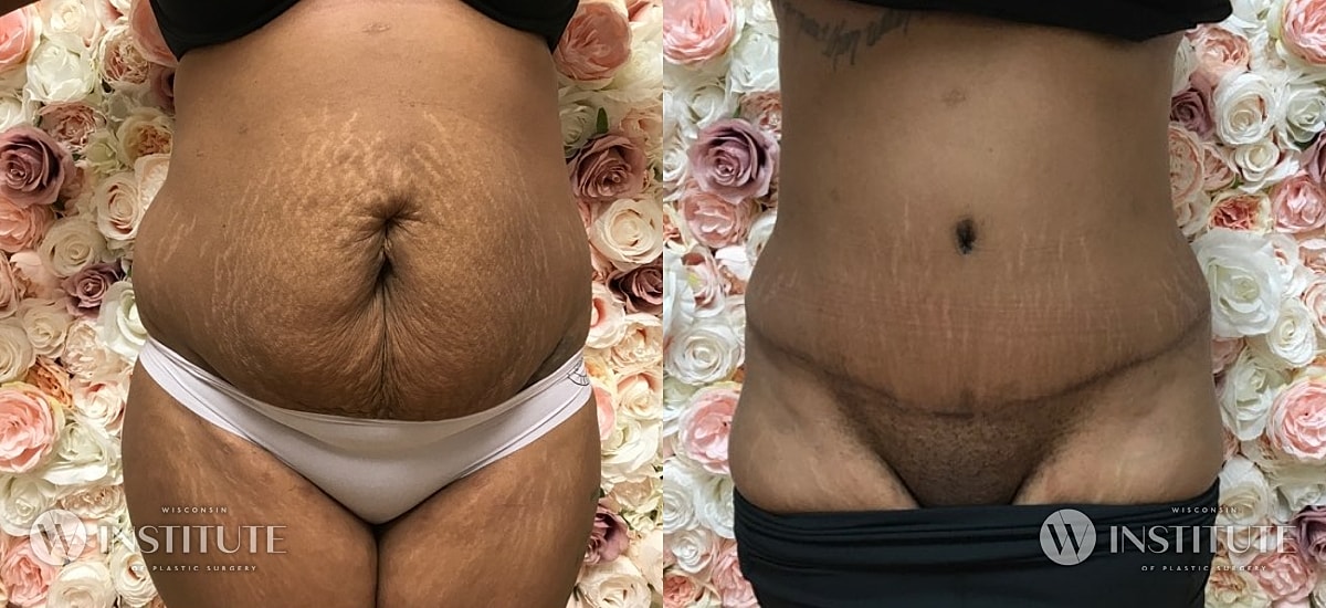 Tummy Tuck Before & After