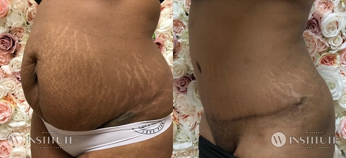 Tummy Tuck Before & After