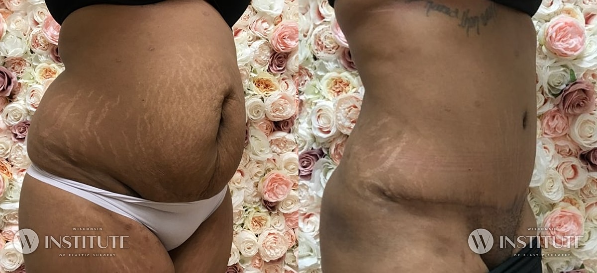 Tummy Tuck Before & After