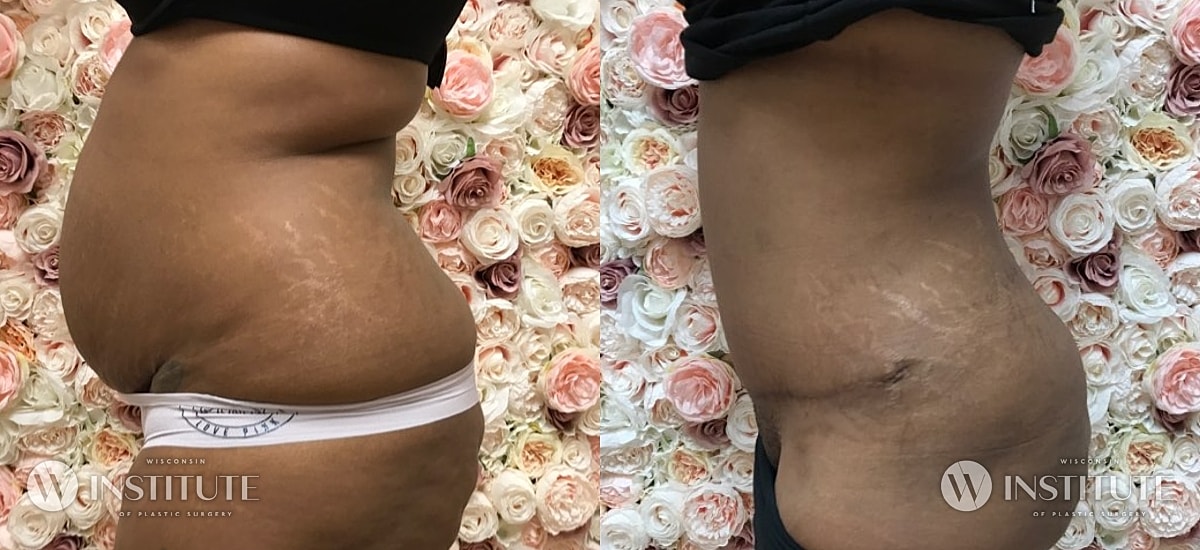 Tummy Tuck Before & After