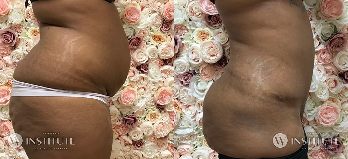 Tummy Tuck Before & After