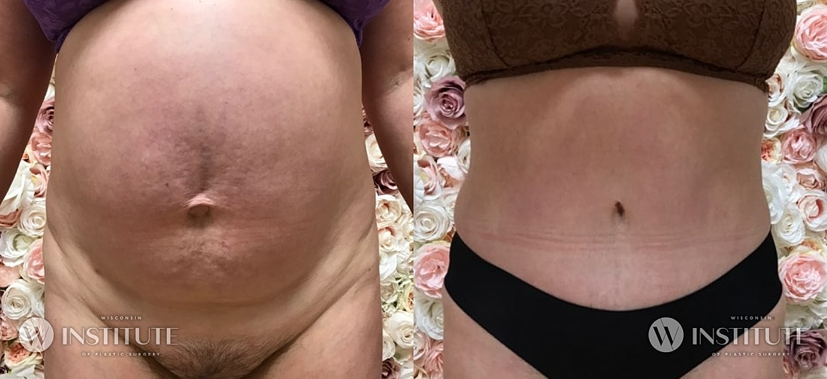 Tummy Tuck Before & After