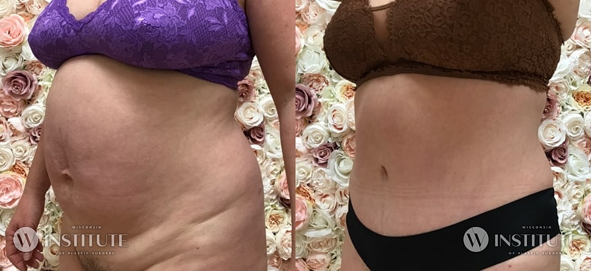 Tummy Tuck Before & After