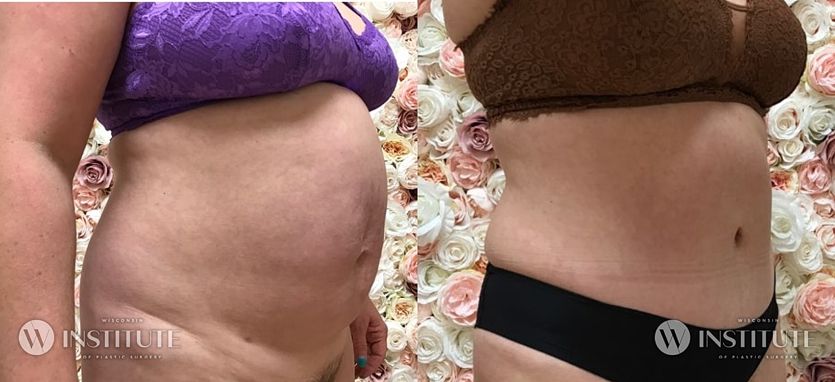 Tummy Tuck Before & After