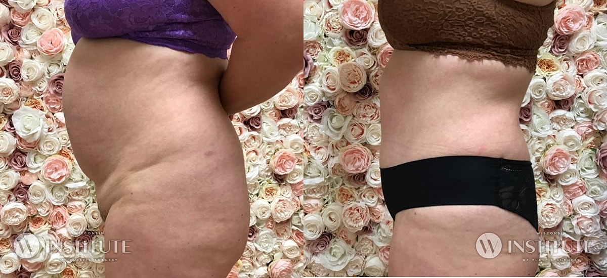 Tummy Tuck Before & After