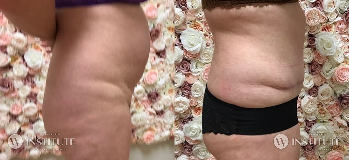 Tummy Tuck Before & After