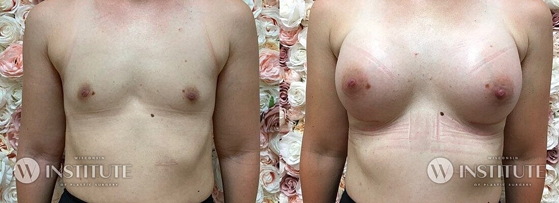 Breast Augmentation Before & After