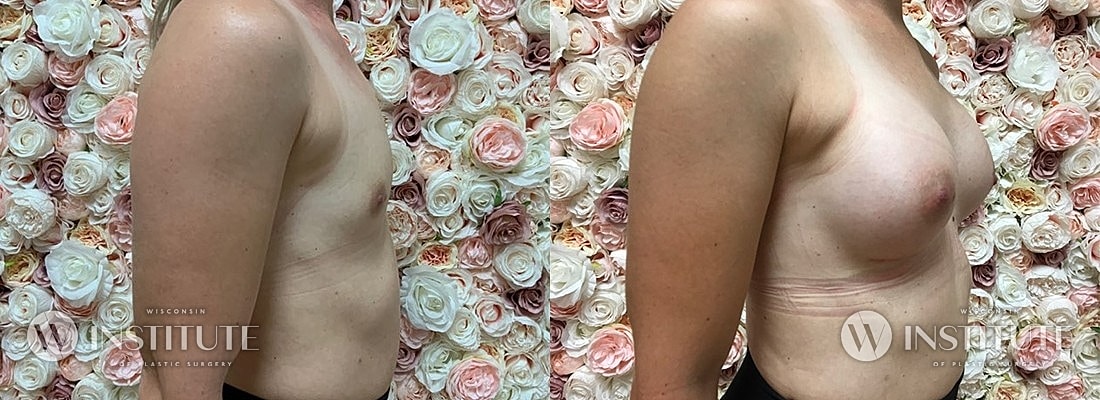 Breast Augmentation Before & After