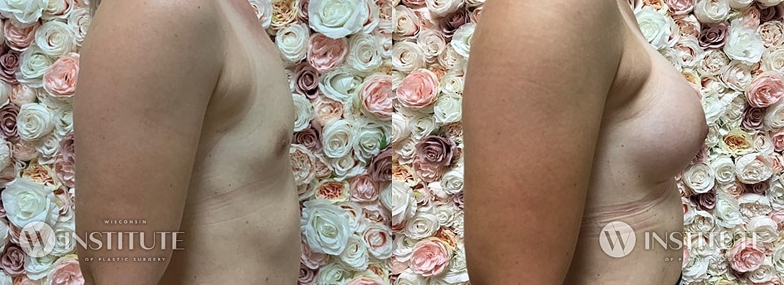 Breast Augmentation Before & After