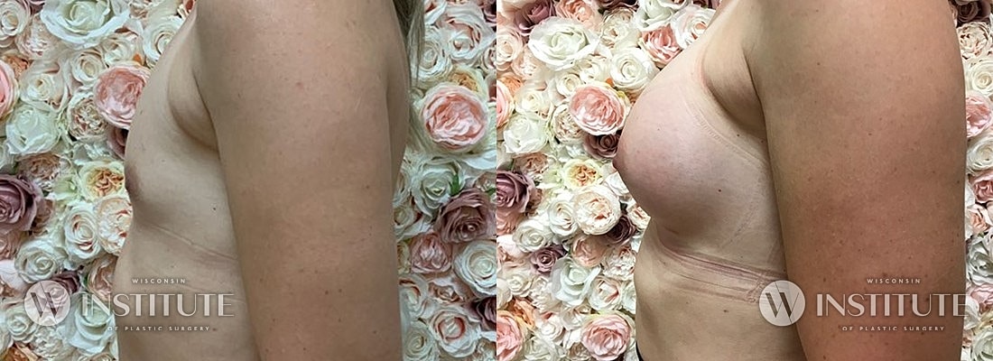 Breast Augmentation Before & After