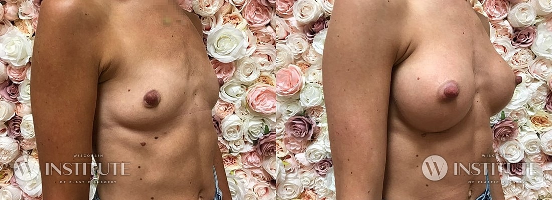 Breast Augmentation Before & After