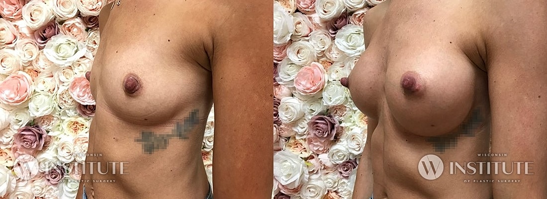 Breast Augmentation Before & After