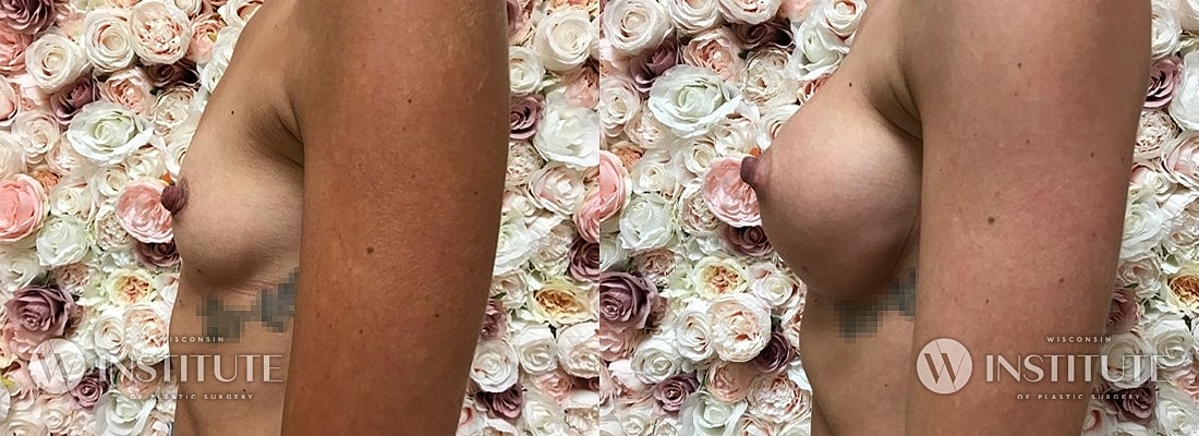 Breast Augmentation Before & After