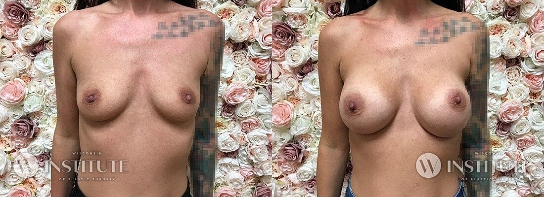Breast Augmentation Before & After