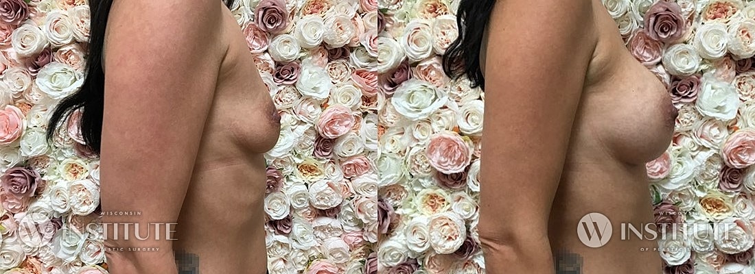 Breast Augmentation Before & After