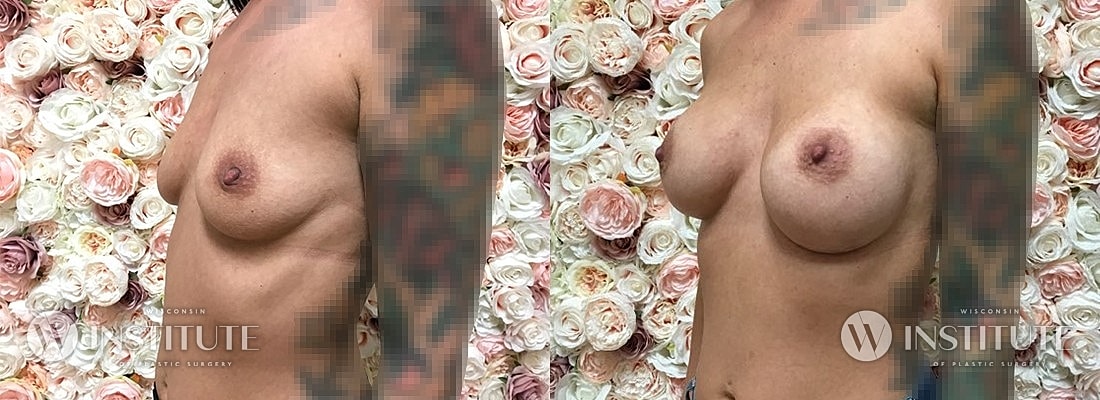 Breast Augmentation Before & After