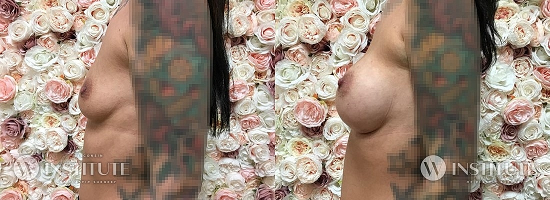 Breast Augmentation Before & After