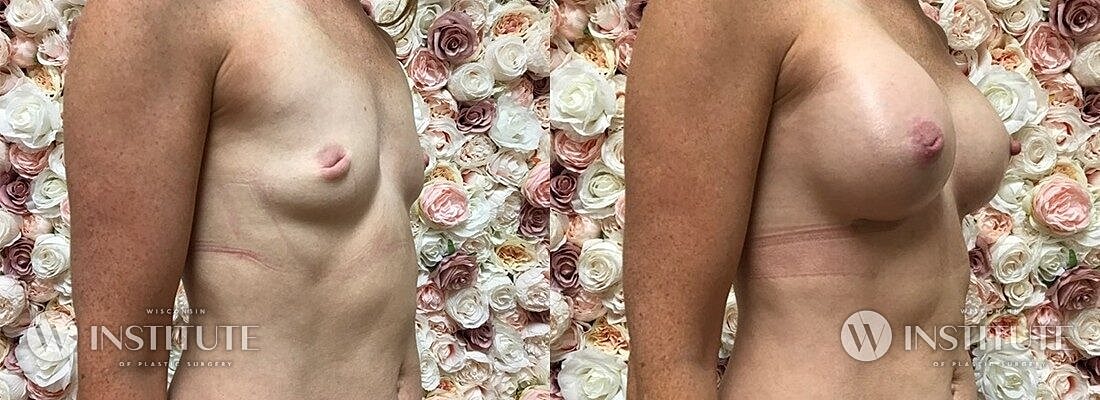 Breast Augmentation Before & After