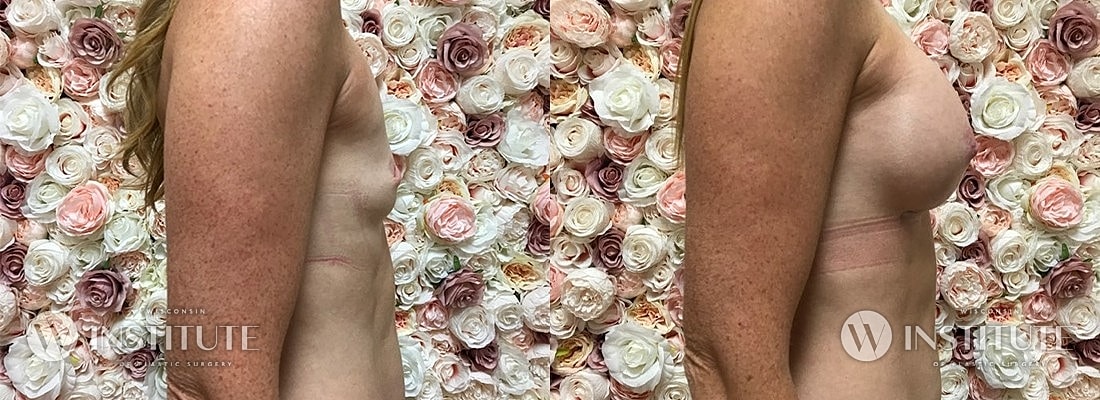 Breast Augmentation Before & After