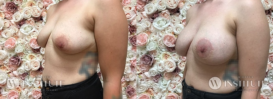 Breast Augmentation Before & After