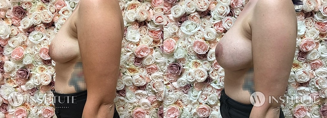 Breast Augmentation Before & After