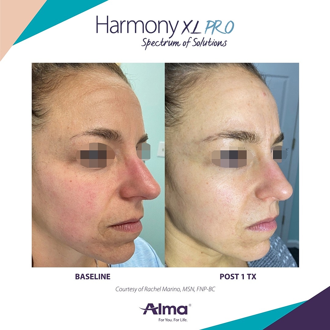 Rosacea Treatment Before & After