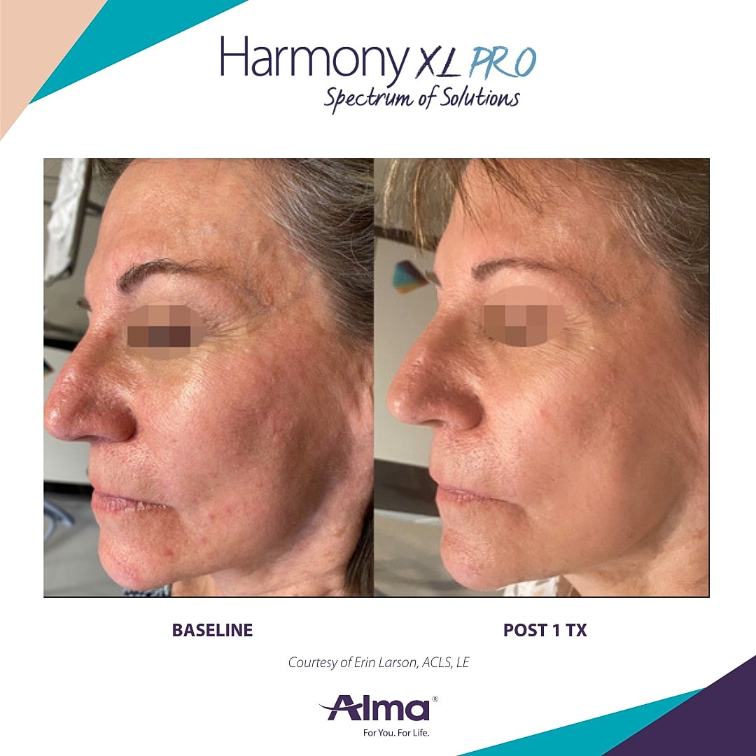 Before and after skin treatment comparison.
