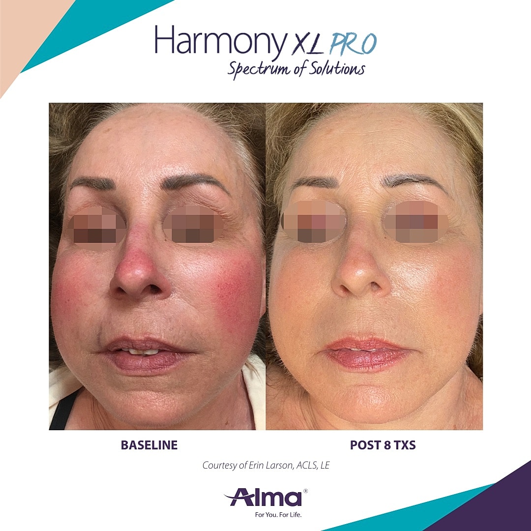 Rosacea Treatment Before & After
