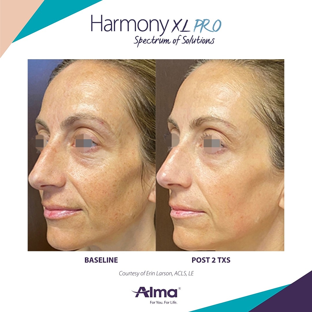 Photofacial Before & After