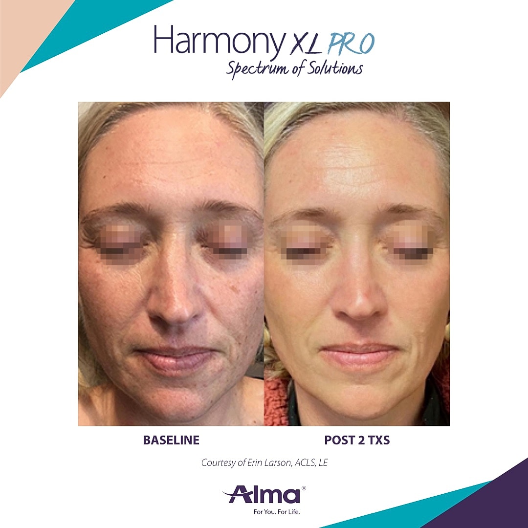 Before and after skin treatment comparison image.