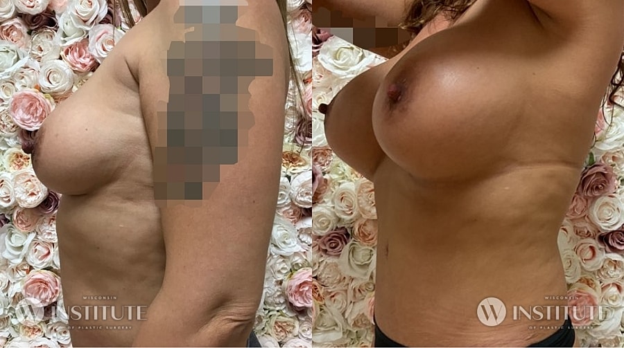 Mommy Makeover Before & After