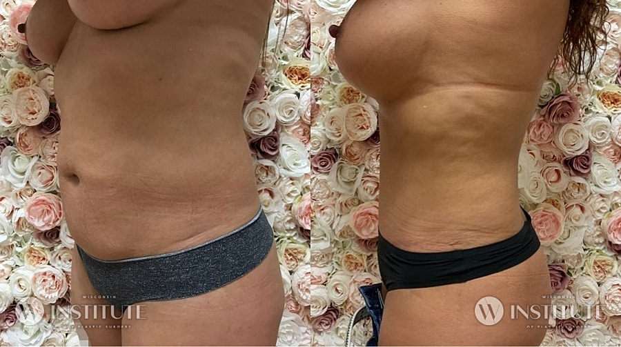 Mommy Makeover Before & After