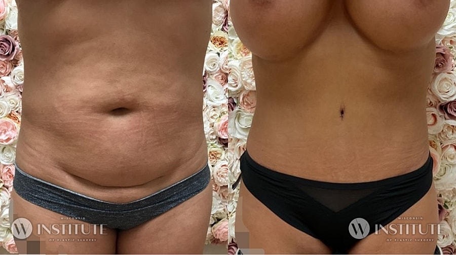 Mommy Makeover Before & After