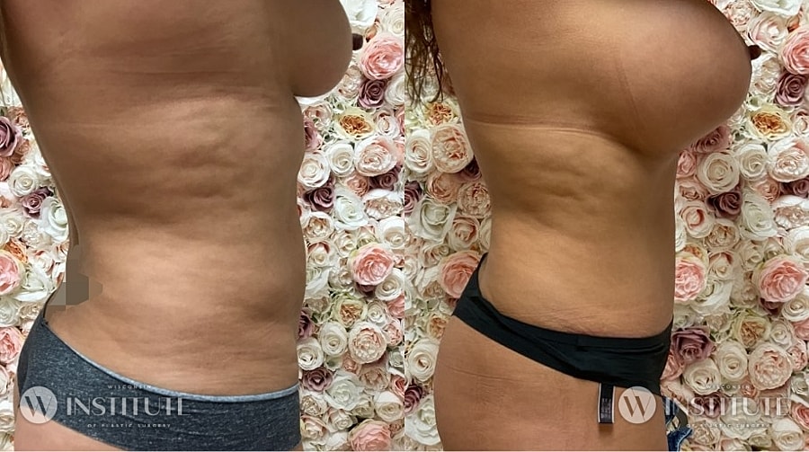 Mommy Makeover Before & After