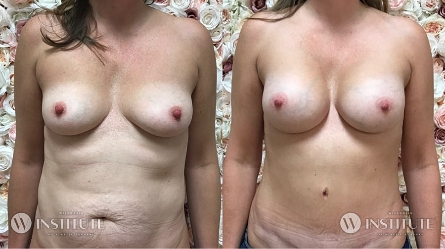 Mommy Makeover Before & After