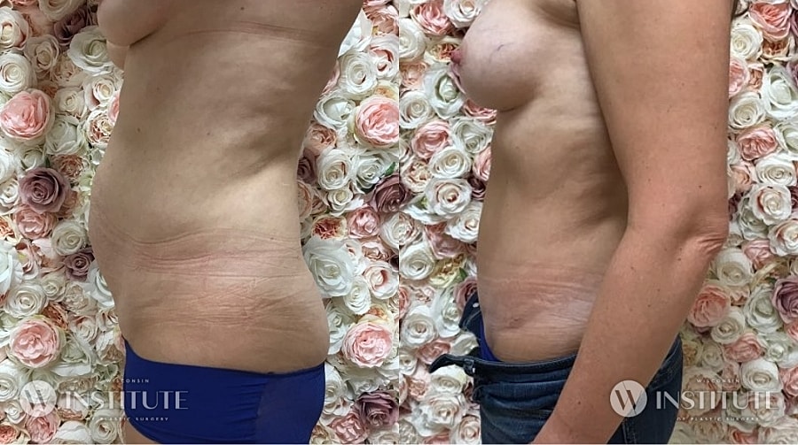 Mommy Makeover Before & After