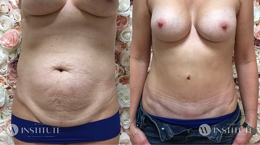 Mommy Makeover Before & After