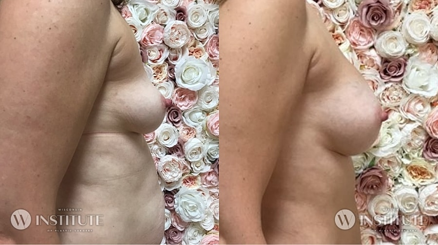 Mommy Makeover Before & After