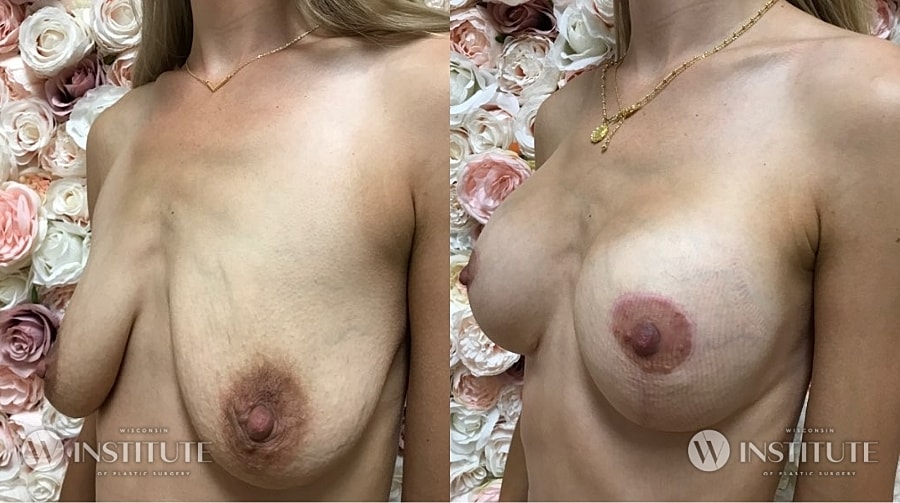 Mommy Makeover Before & After