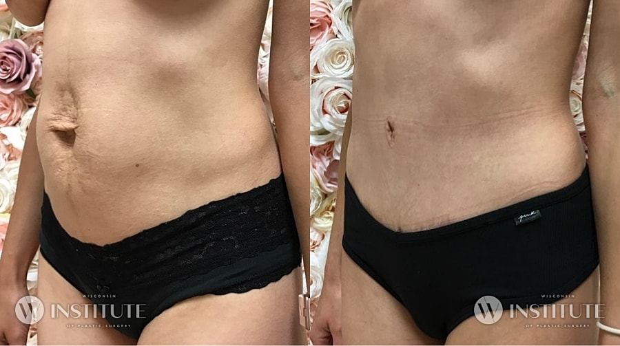 Mommy Makeover Before & After