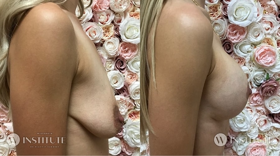Mommy Makeover Before & After