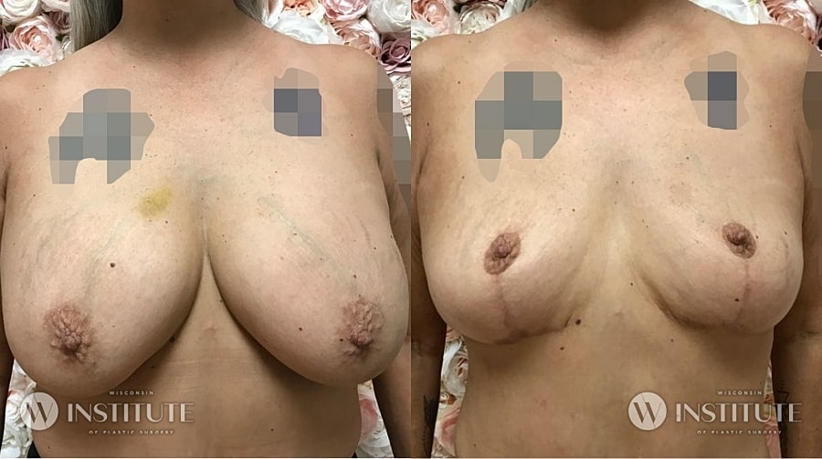 Mommy Makeover Before & After