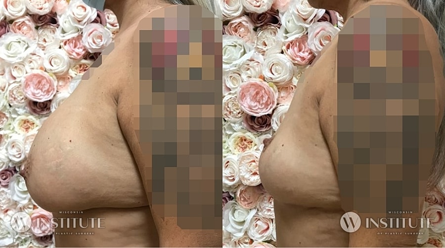 Mommy Makeover Before & After