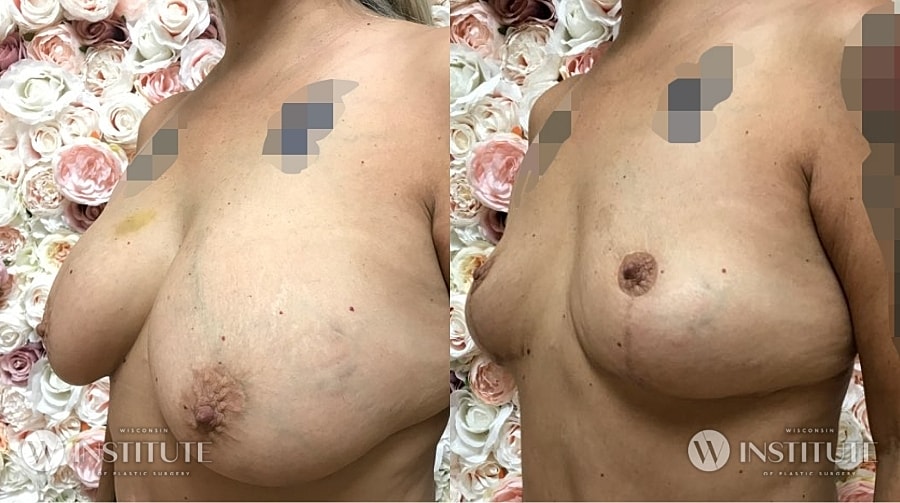 Mommy Makeover Before & After