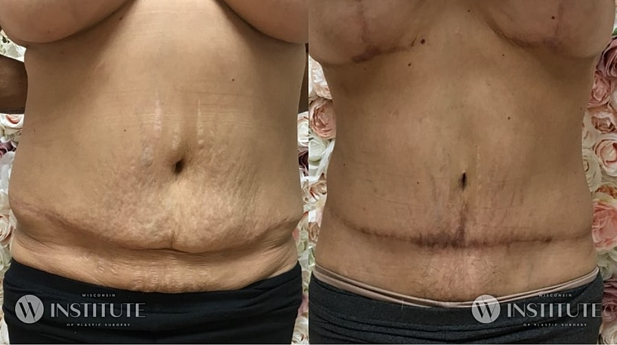Mommy Makeover Before & After