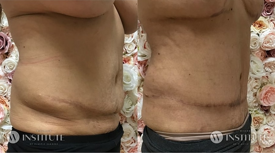 Mommy Makeover Before & After