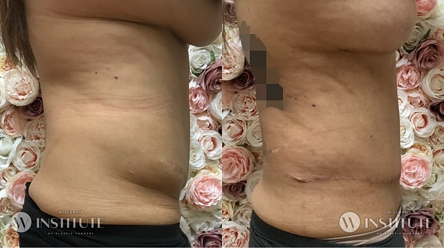 Mommy Makeover Before & After