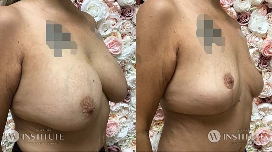 Mommy Makeover Before & After