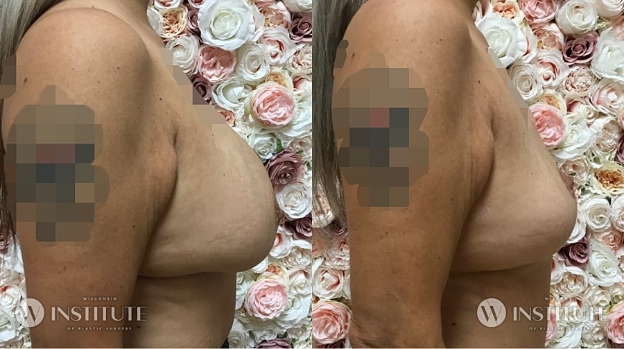 Mommy Makeover Before & After