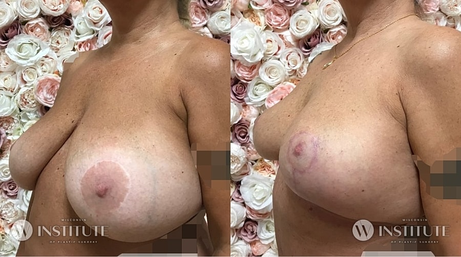 Mommy Makeover Before & After